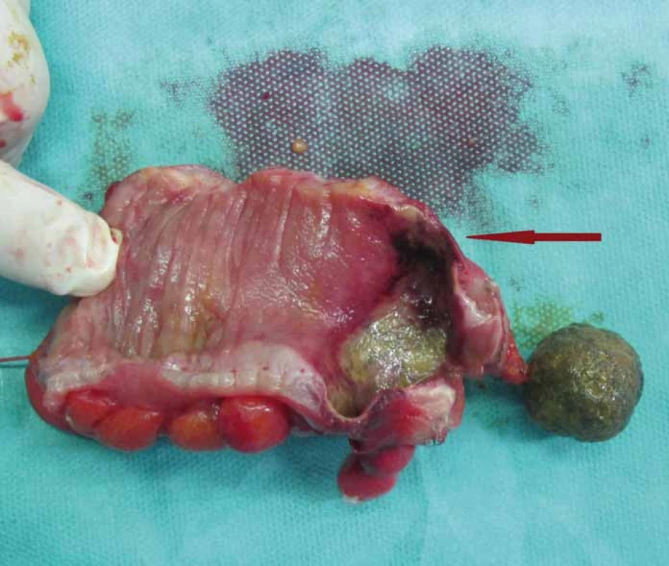 Preparát dekubitus a nekróza stěny orálního rekta (označeno šipkou).
Fig. 3. Decubitus ulcer and rectum wall necrosis (indicated by an arrow).
