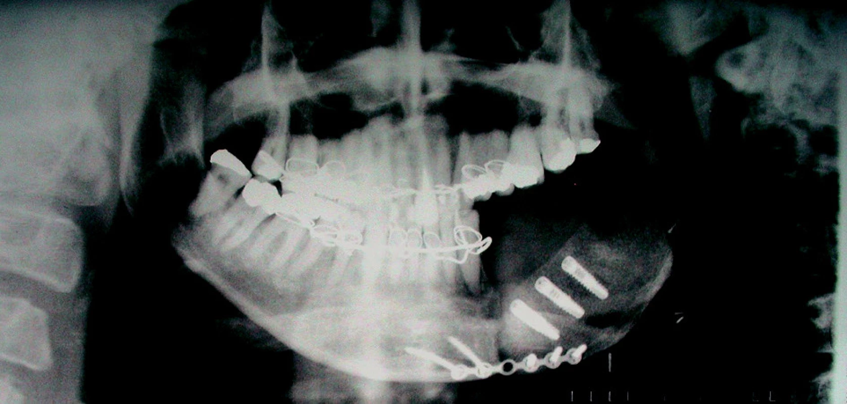 Stav po přenosu kostního štěpu se zavedenými implantáty – Rtg PAN.