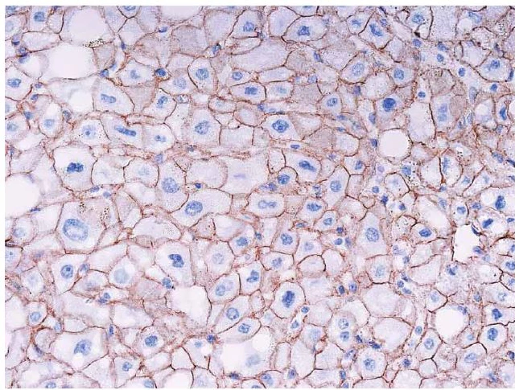 Imunohistochemický průkaz β-cateninu. Normální membránová pozitivita v adenomu (tj. bez mutace β-cateninu).
Fig. 7. Immunohistochemical detection of β-catenin. Normal membrane positivity in adenoma (i.e. without a mutation of β-catenin).