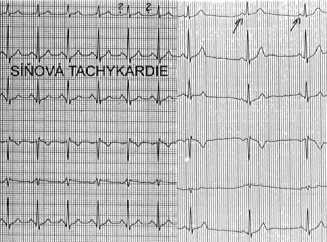 Síňová tachykardie. V prvních 6 QRS-komplexech běží síňová tachykardie, poslední 3 QRS-komplexy představují sinusový rytmus. Morfologie P-vln při tachykardii se liší od morfologie P-vln při sinusovém rytmu prakticky jen ve svodu I, nicméně to stačí k diagnostice síňové tachykardie s vyloučením možnosti sinusové tachykardie.