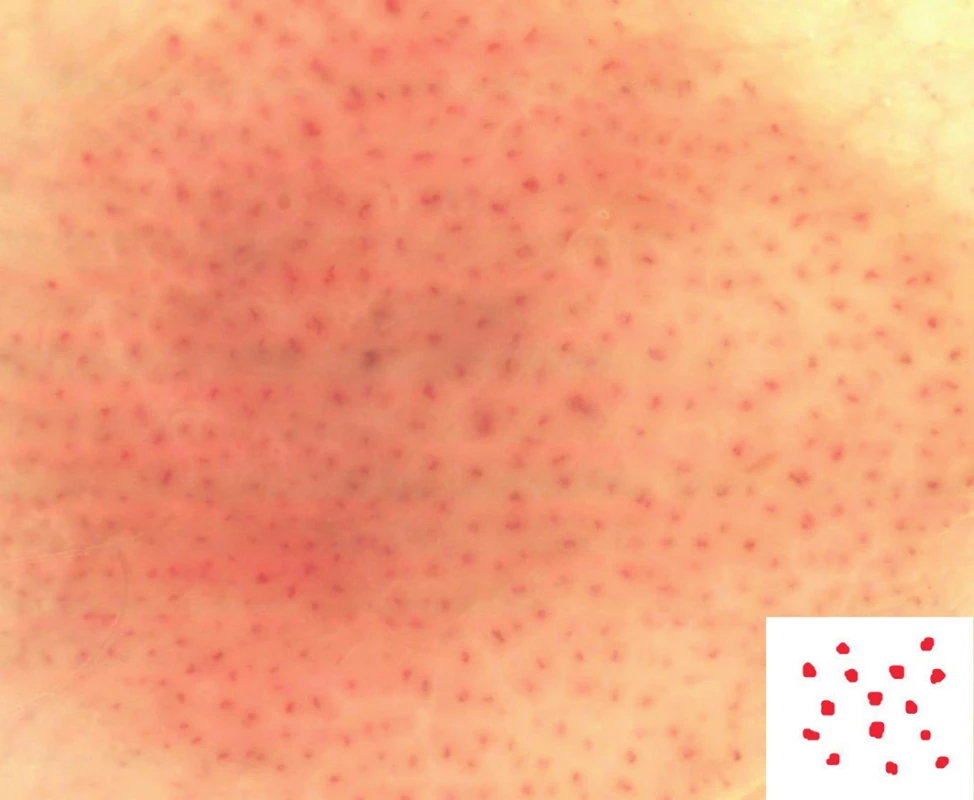 Tečkovité cévy (nevus Spitzové)