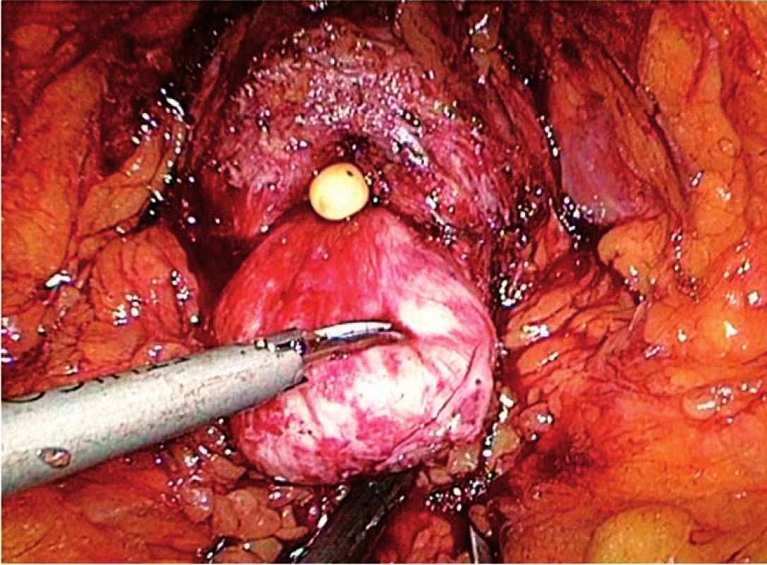 Velký střední lalok prostaty po oddělení předního obvodu hrdla močového měchýře
Fig. 4. Large prostatic middle lobe after incision of the bladder neck anterior wall