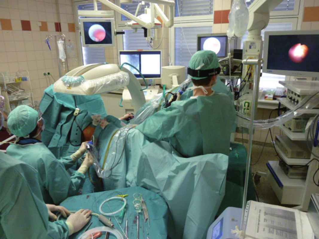 Kombinovaný intrarenální přístup – ECIRS (flexibilní ureterorenoskopie + perkutánní nefrolitotrypse) – na operačním sále
Fig. 2. Combined intrarenal approach – ECIRS (flexible ureterorenoscopy + percutaneous nephrolithotripsy) – at the operating theatre