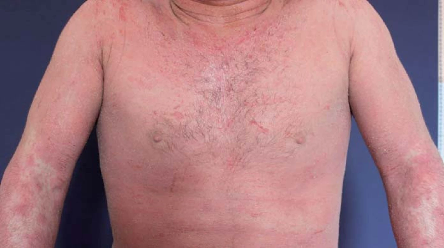 Atopická dermatitida.
Fig. 4. Atopic dermatitis.