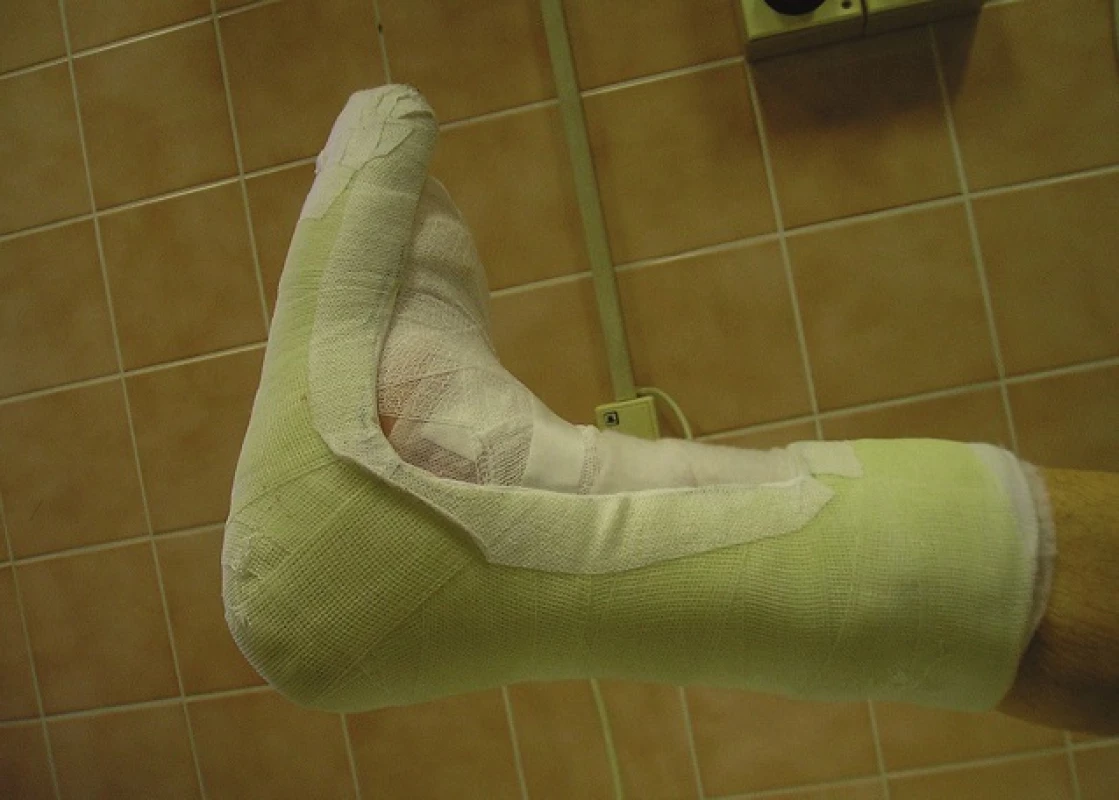 Kontaktní snímatelná dlaha
Fig. 3: Removable contact splint (RCS)