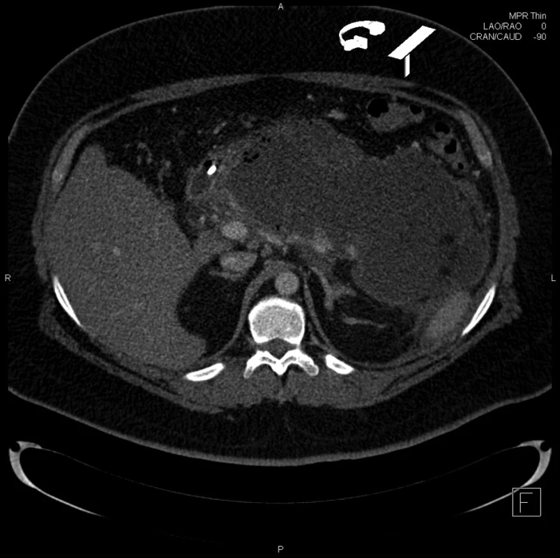 CT obraz rozsáhlé nekrózy pankreatu
Fig. 1: CT of extensive pancreatic necrosis