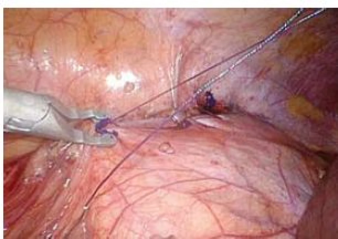 Peritoneum je uzavíráno pokračujícím polyglaktinovým stehem kotveným pomocí PDS klipů
Fig. 7. Peritoneum is closed with running suture (polyglactine) anchored with PDS clips