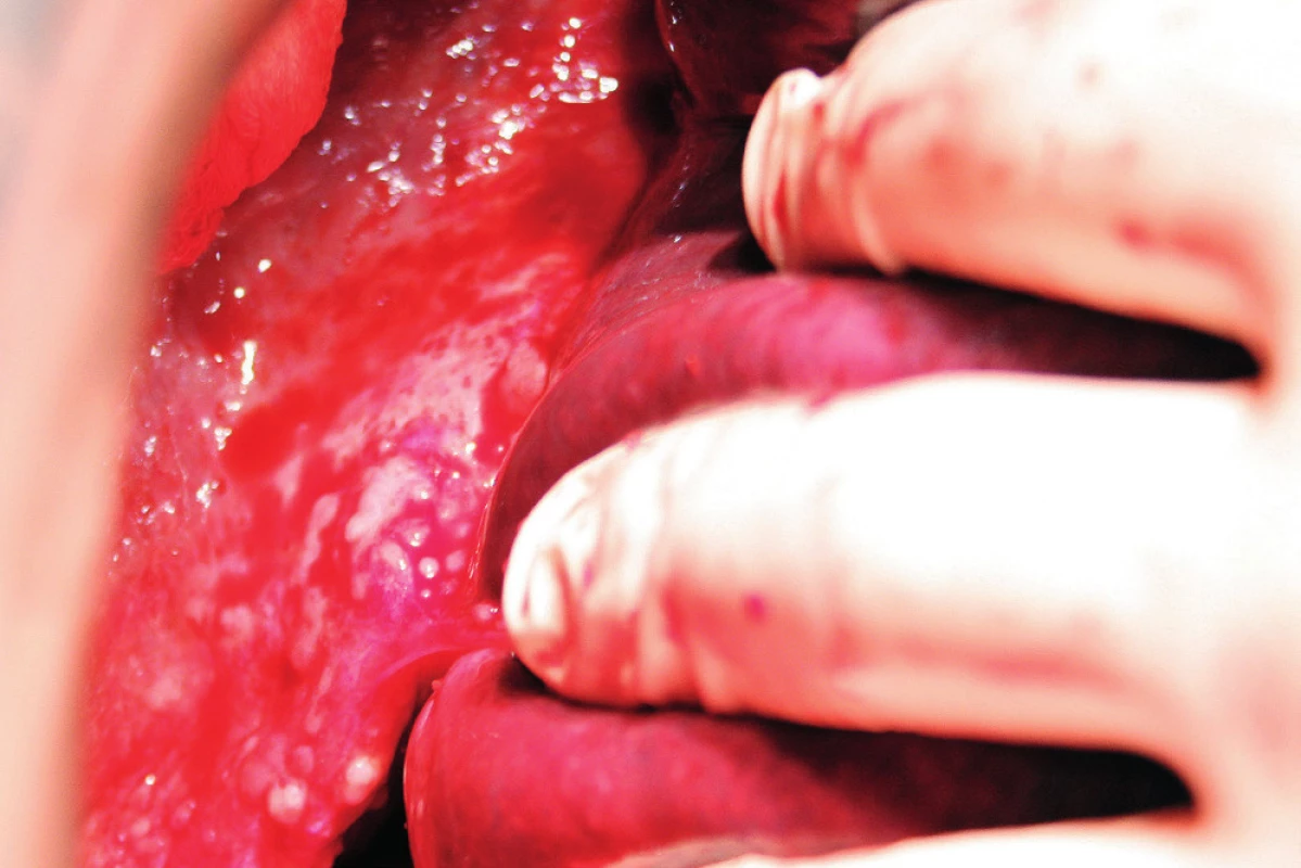 Ligamentum coronarium a triangulare hepatis a jejích přímý přechod z jater na bránici