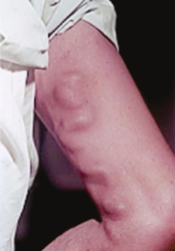 Klinický obraz ascendentní tromboflebitidy VSM až k SF junkci
Fig. 3: Clinical picture of ascending thrombophlebitis of GSV to SF junction