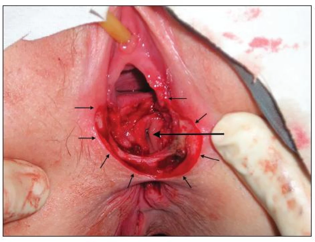 Okraje incízie perinea (malé šípky) s rozšírením vchodu do pošvy; perforácia rekta a vagíny (veľká šípka)
Fig. 2. Edges of the perineal incision (small arrows) with widening of the vaginal entrance; perforation of the rectum and vagina (large arrow)