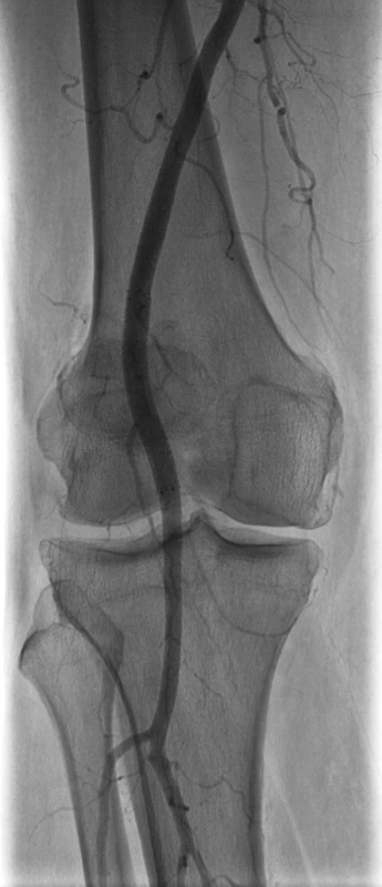 Kontrolná angiografia po dodilatácii s obnovením toku v kompletnom rozsahu pravého lúmen arteria poplitea vpravo
Fig. 3. Controlled angiography following final dilation with complete blood flow resolution in the right popliteal artery