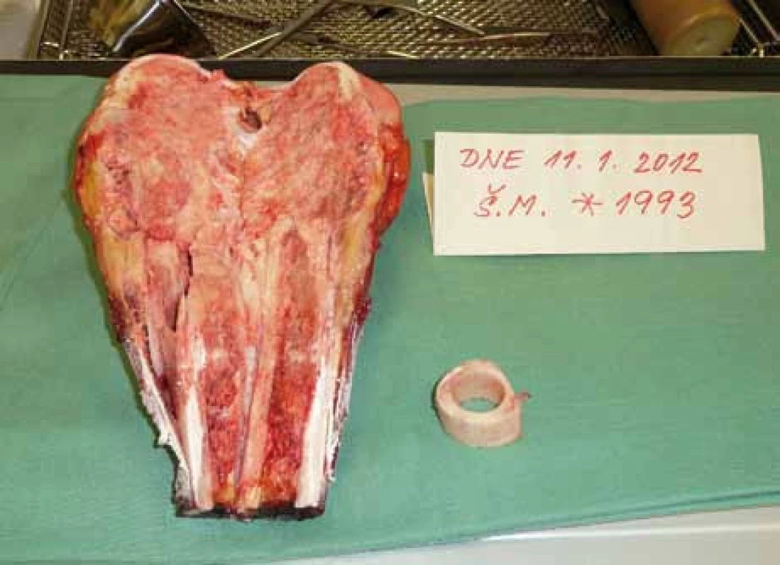 Peroperační preparát – osteosarkom distálního femuru, osteoblastická varianta.