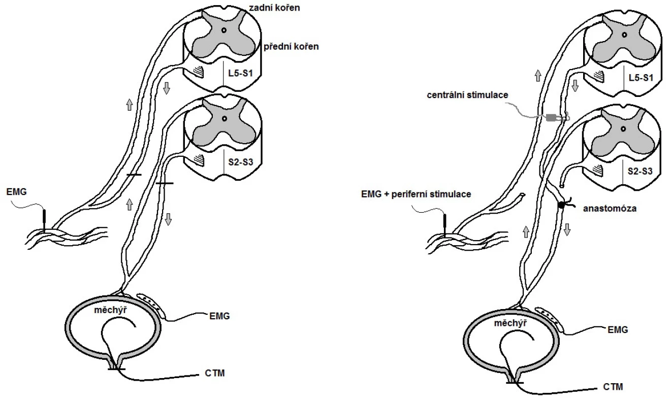 Schéma remodelace mikčního reflexního oblouku
Fig. 2. Scheme of artieficial skin-CNS-bladder pathway
