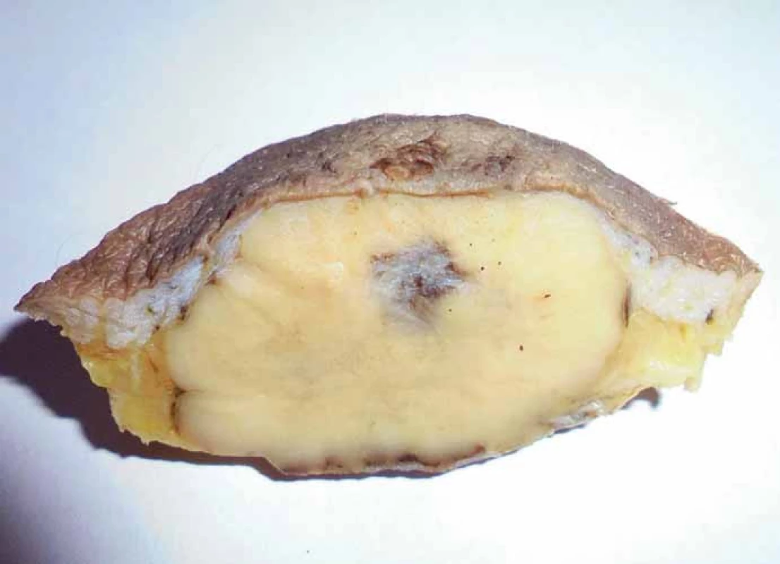 Resection specimen with a visible large tumor mass (post fi xation in formalin).