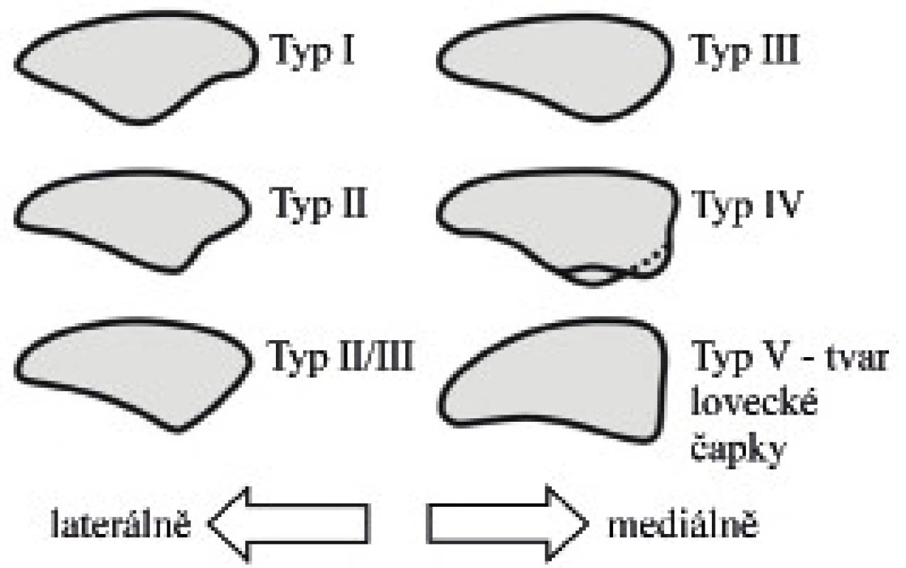 Wiberg-Baumgartlova klasifikace dysplazie pately.
Fig. 1. Wiberg-Baumgartl classification of patellar dysplasia.