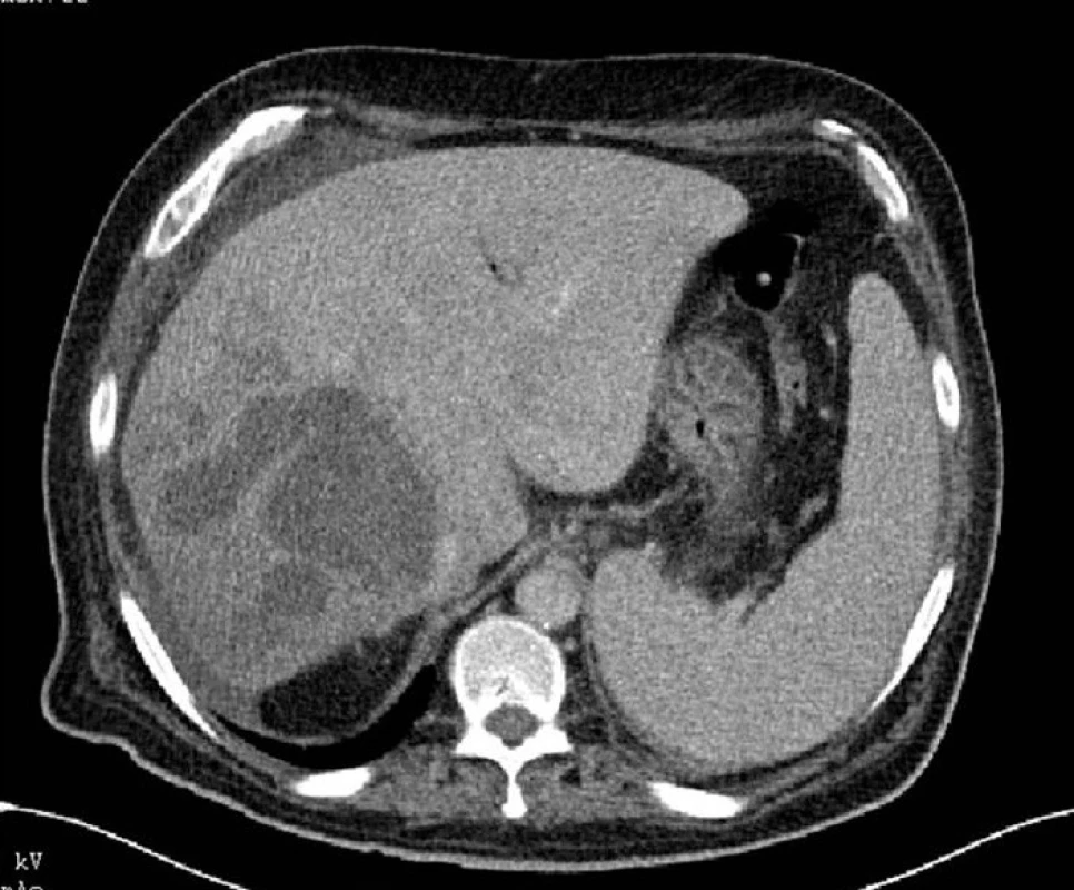 Žilní fáze CT jater s kontrastní látkou prokazuje rozsáhlý zánětlivý proces v pravém laloku jater
Fig. 6: CT image venous phase with contrast medium demonstrating an extensive inflammatory process in the right hepatic lobe