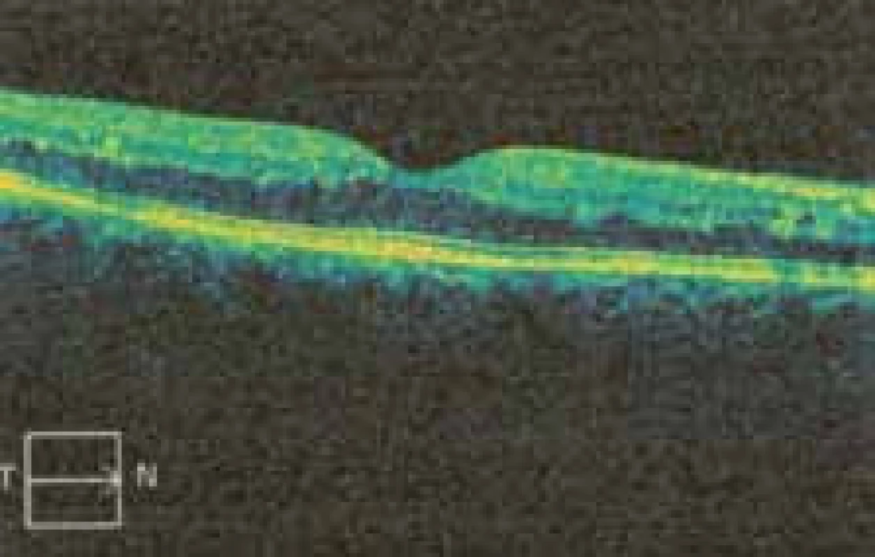 OCT scan makuly 14 týdnů po porodu se spontánním vymizením edému.