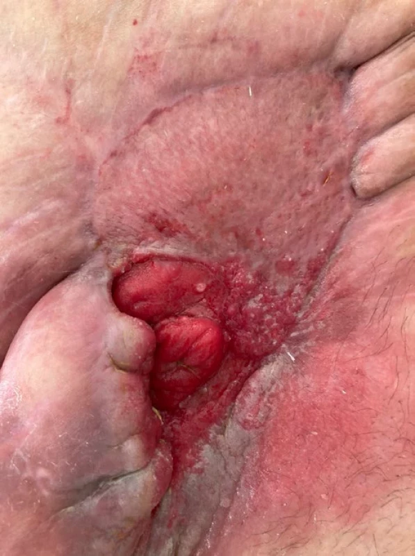 EAF vyhojená pomocí dermoepidermálního štěpu v enterokutánní píštěl.