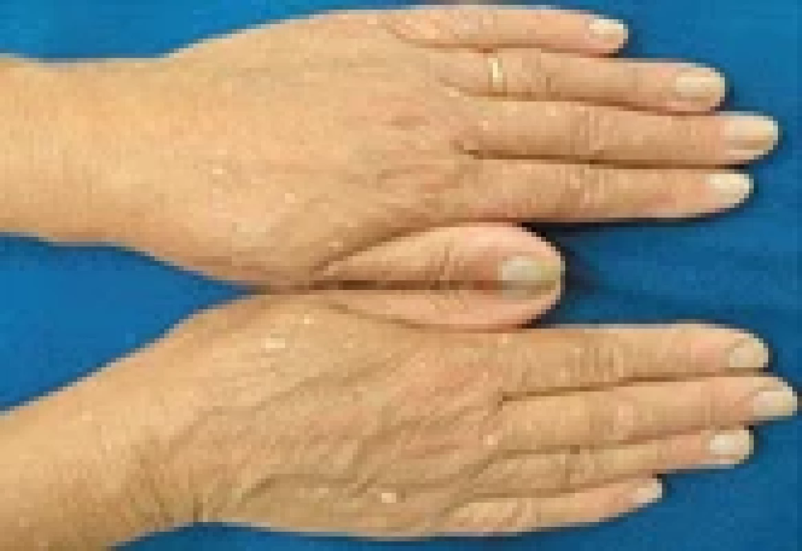 Kožní léze na rukou ve formě hamartomů. Fig. 1. Skin lesions on the hands in the form of hamartomas.