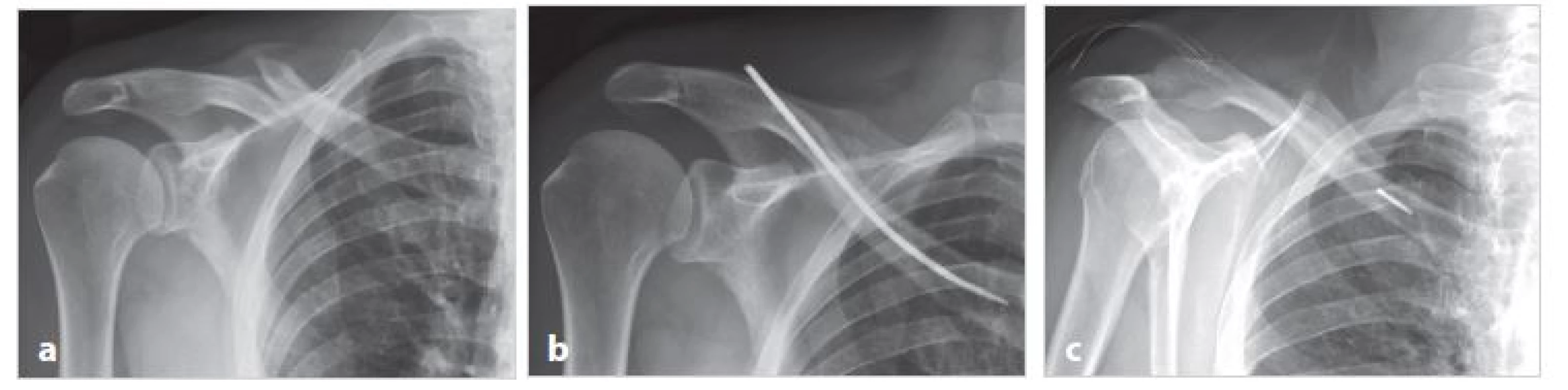 Dobré hojení zlomeniny a zlomení implantátu při jeho extrakci (muž T. E., 59 let)
a) úrazové snímky dvoufragmentové zlomeniny; b) pět měsíců po operaci zlomenina zhojena v anatomickém postavení; c) šest měsíců po operaci došlo při extrakci implantátu k odlomení jeho mediální části, která ponechána in situ
Fig. 3: Good healing of fracture and breakage of implant during its extraction (male T.E., 59 years)
a) X-ray of a two-fragment fracture taken after the injury; b) five months after surgery, the fracture is healed in anatomical position;
c) six months after the surgery, the implant was broken during its extraction, the medial part of pin was left in the bone