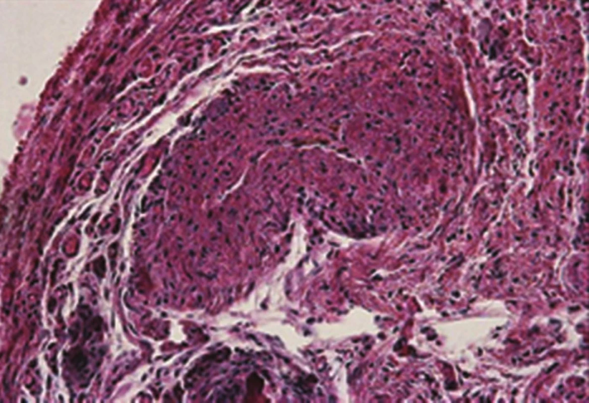 Histologický preparát uzávěru žíly po 4 týdnech laserem
Fig. 2: Histology specimen following the vein closure after 4 weeks of laser therapy