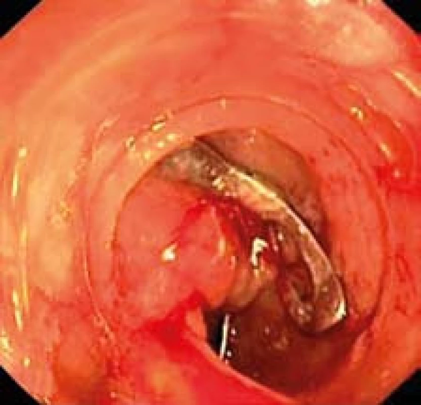 Zaklipovaná perforace pomocí OT SC<sup>®</sup> klipu.
Fig. 4. Perforation closed with an OTSC<sup>®</sup>.