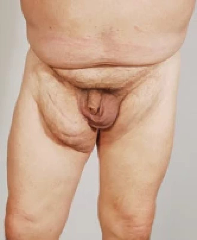 Lymphedema of right lower limb after multiple surgeries of recurrent lipoma of groin (patient No. 8).