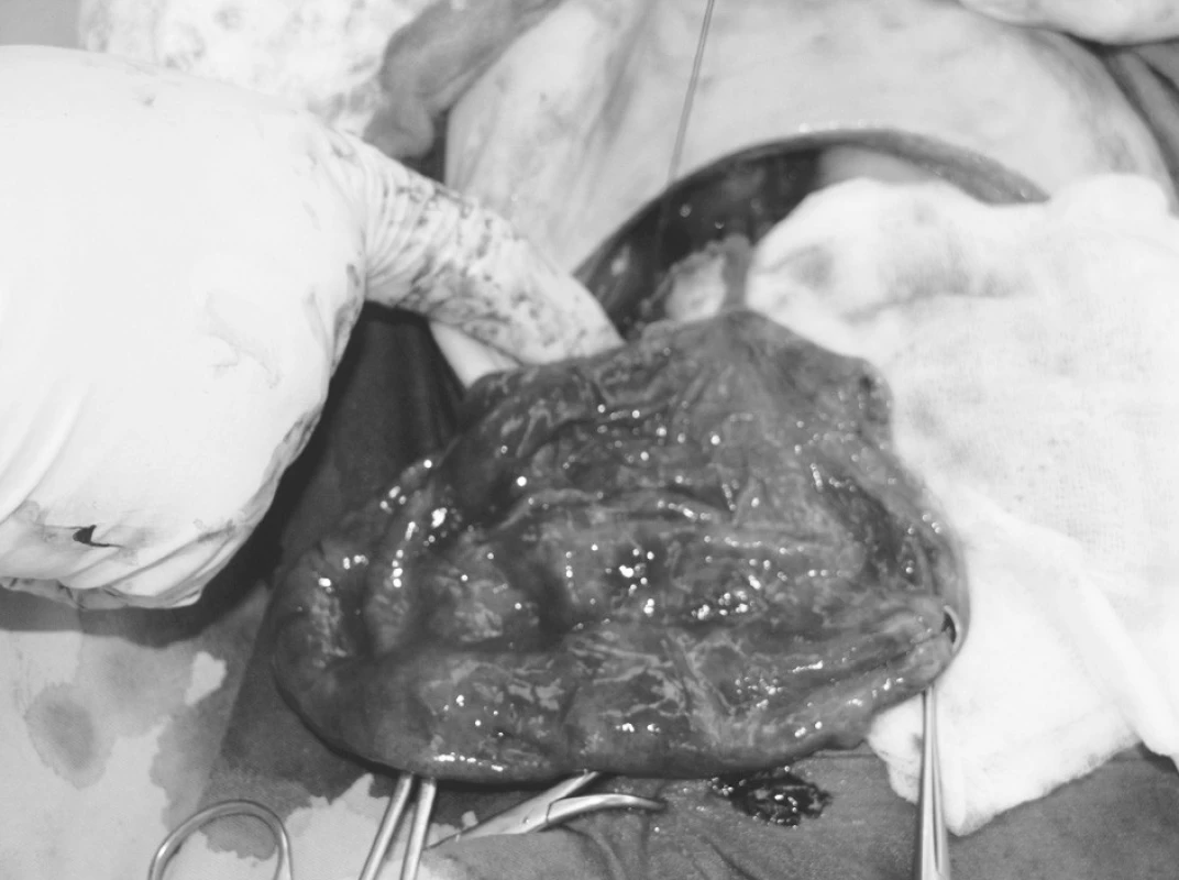 Púzdro cysty
Pic. 6. A capsule of the cyst