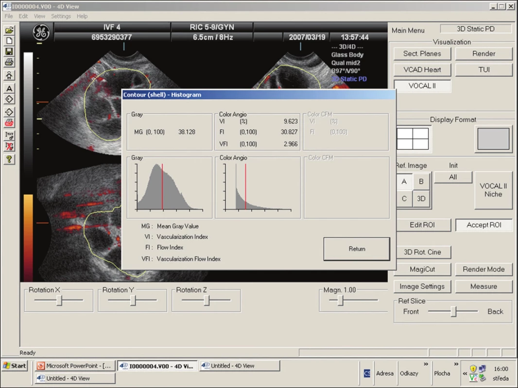 Zhodnocení ovariální vaskularity pomocí 3D power doppler: pro výpočet VI, FI, VFI bylo využito zobrazovacího programu VOCAL, hodnotícího jak objemové parametry, tak krevní tok skrze cílový objem za užití barevného histogramu. Všechny hodnoty jsou udávány jako průměr ze tří standardně prováděných měření. Dominantní folikul byl stanoven jako folikul s maximální střední hodnotou folikulárního průměru (MD). Folikulární objem byl určen podle vzorce: FV(ml) = 4,1888 x (MD/2 (cm))<sup>3</sup>.