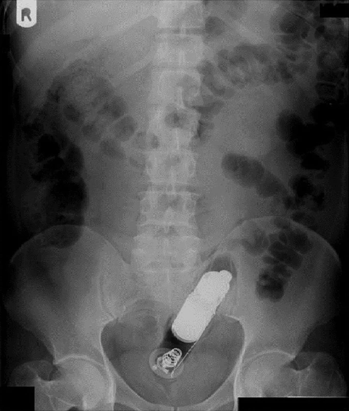 Vibrátor v rektu
Fig. 1: A vibrator in the rectum