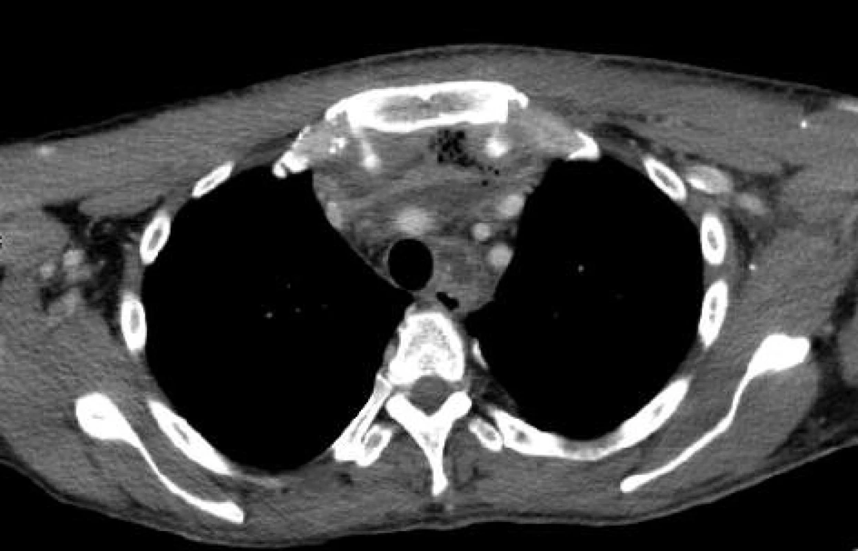 CT obraz - rozsáhlý absces zasahující do předního mediastina
Fig. 3: CT image – a large abscess spreading to the anterior mediastinum