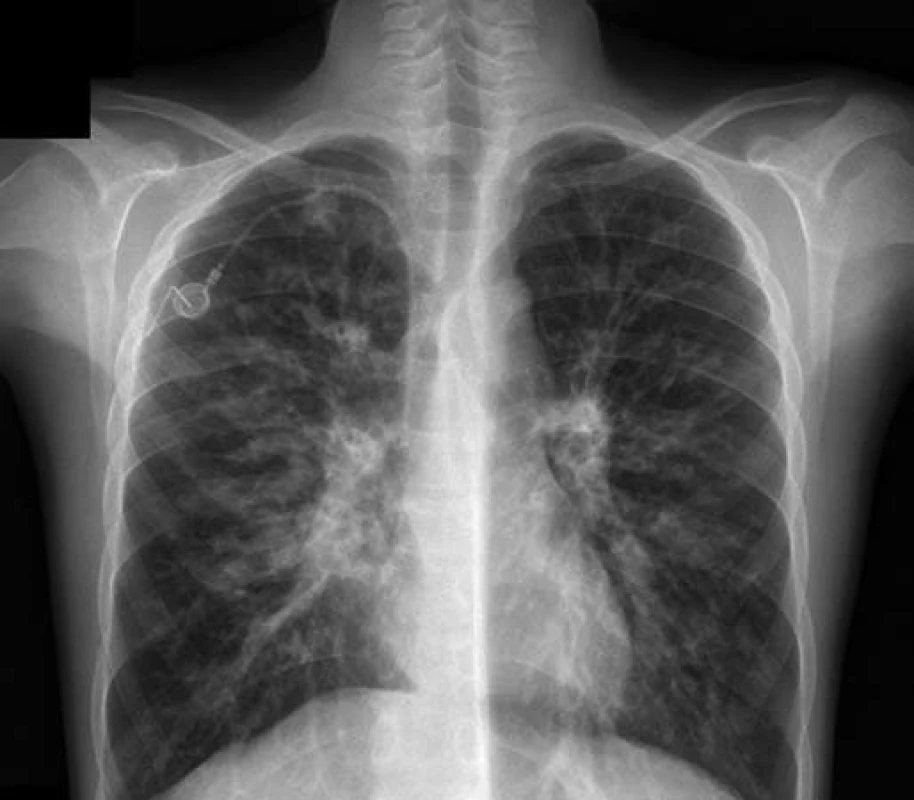 Podkožní komůrka (implantable access port). Konec katétru je zavedený do v. subclavia vpravo. Na obrázku je viditelná i speciální aplikační jehla v komůrce tohoto systému.