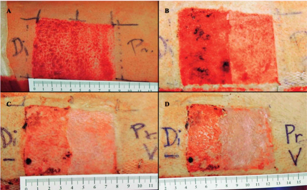 Donor site wound healing (Pr.– proximal part with application of Oleogel-S10). A – Immediately after surgical procedure, B – 2<sup>nd</sup> day post procedure, C – 7<sup>th</sup> day post procedure, D – 9<sup>th</sup> day post procedure – complete wound closure (end of treatment)