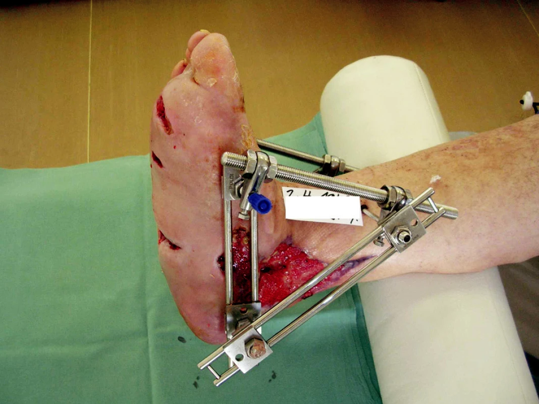 Zevní fixátor u pacienta s Charcotovou osteoar-      tropatií, pes cavus, rozsáhlými defekty penetrujícími do Chopartova skloubení 
Fig. 1. External fixator in a patient suffering from Charcot’s osteorthropathy, pes cavus, with major defects penetrating into the Chopart’s joint 
