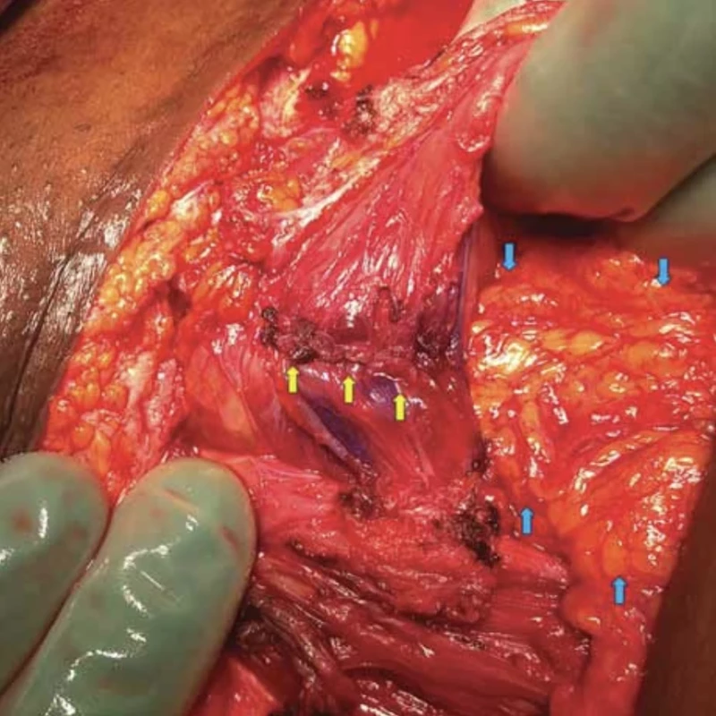 Yellow arrows – bladder fundus suture, blue arrows – omentum fixed between the bladder suture and anterior uterine wall suture (published with the patient's permission). // Žluté šipky – sutura fundu močového měchýře, modré šipky – omentum fixované mezi suturu močového měchýře a suturu přední stěny děložní (publikováno se svolením pacientky).