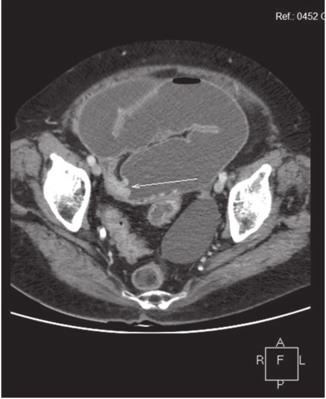 CT obraz entero-enterální invaginace
Fig. 5: CT image of the entero-enteral invagination