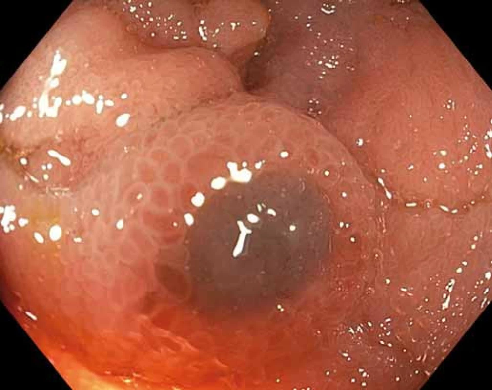 Léze vzhledu „volského oka“ velikosti 5 mm v ileu, ve zvětšení Near Focus.
Fig. 4. Bull’s eye lesion of the ileum, 5 mm in diameter, magnified with Near Focus.