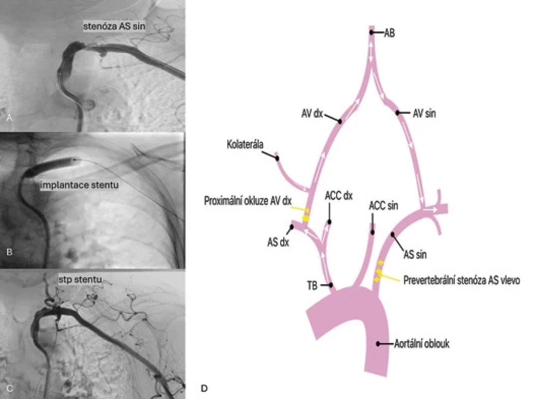 (A–C) Angiografi e AS vlevo. (A) Mikrokatetr zaveden do odstupu AS a provedena selektivní angiografi e AS. Zobrazila se stenóza s nerovnými okraji stěny tepny. (B) Implantace stentu do stenotického úseku AS. (C) Stav po implantaci stentu do AS. Kontrolní nástřik byl již bez nálezu stenózy. (D) Grafi cké schéma subclavian steal fenoménu naší kazuistiky při hraničně hemodynamické stenóze AS vlevo s proximální okluzí kontralaterální a. vertebralis vpravo.