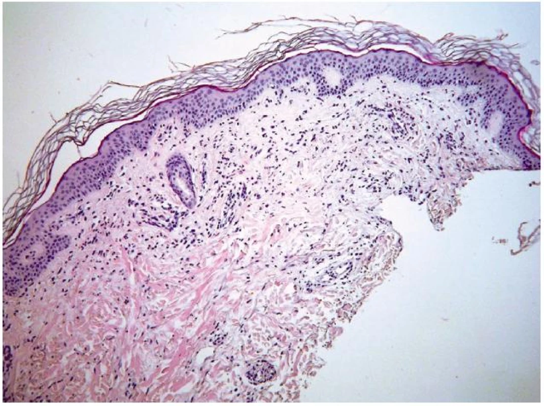 Erythema gyratum repens – histologický obraz
Perivaskulární malé infiltráty z lymfocytů s příměsí eozinofilů v horním koriu (HE, původní zvětšení 200krát).