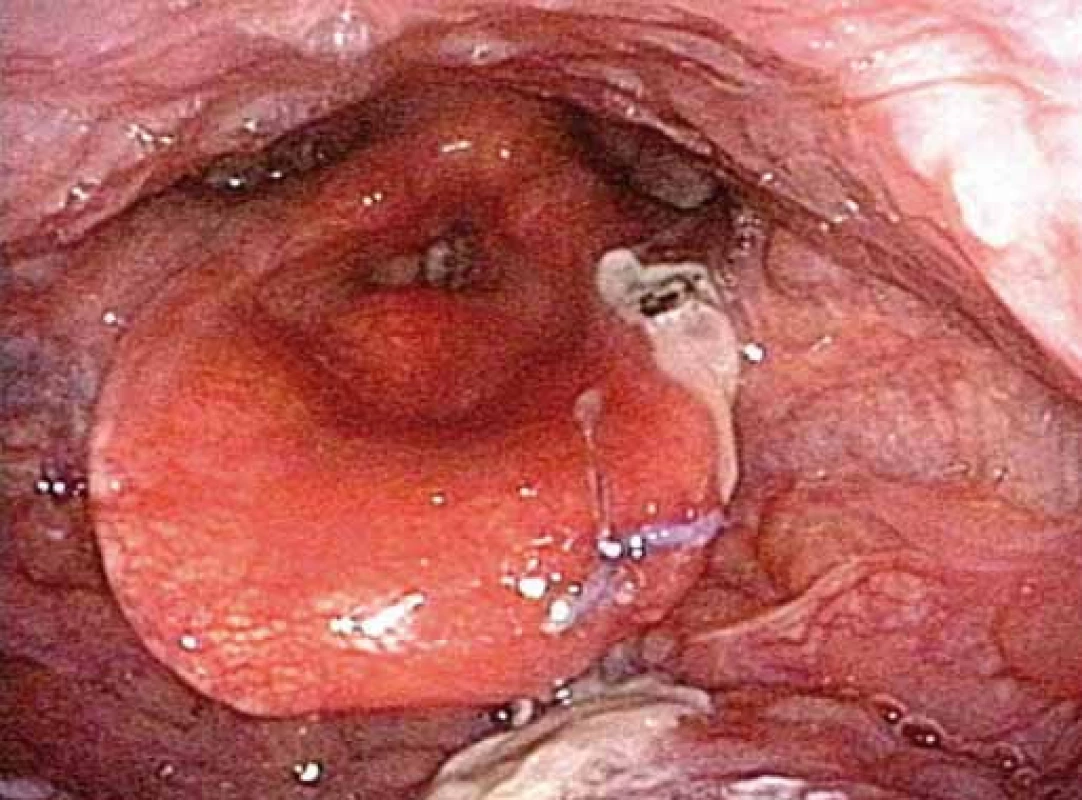 Stav po endoskopické epiglotoplastice s fixací levé části epiglotis ke kořeni jazyka matracovým stehem.
Fig. 5. Situation after endoscopic epiglottis reconstruction with fixation of the left side of the epiglottis to the root of the tongue with a mattress stitch.