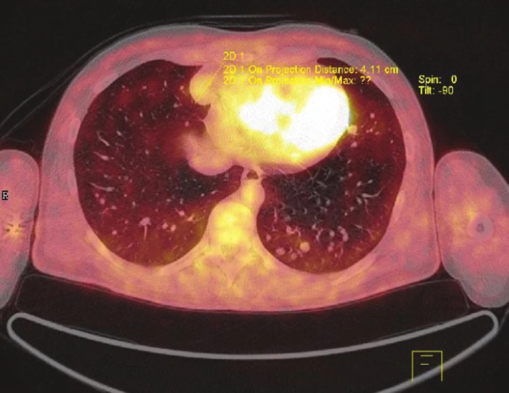 PET/CT Mnohočetné plicní metastázy maligního melanomu
Fig. 3: PET/CT Multiple melanoma metastases to the lung