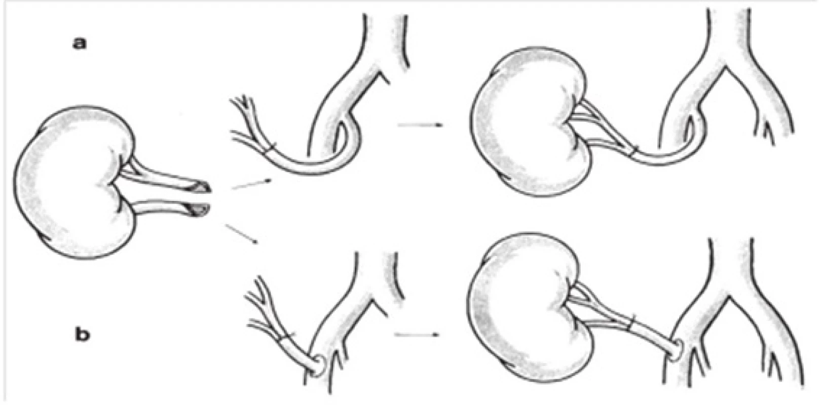 a,b: Oprava poškodenia segmentálnej artérie pomocou side-to-side-spojenej anastomózy a) hypogastickou artériou a b) s darcovským vaskulárnym štepom [11]
Fig. 4. a,b: Repair of segmental artery damage using side-to-side anastomosis with a) hypogastic artery b) donor vascular graft [11]