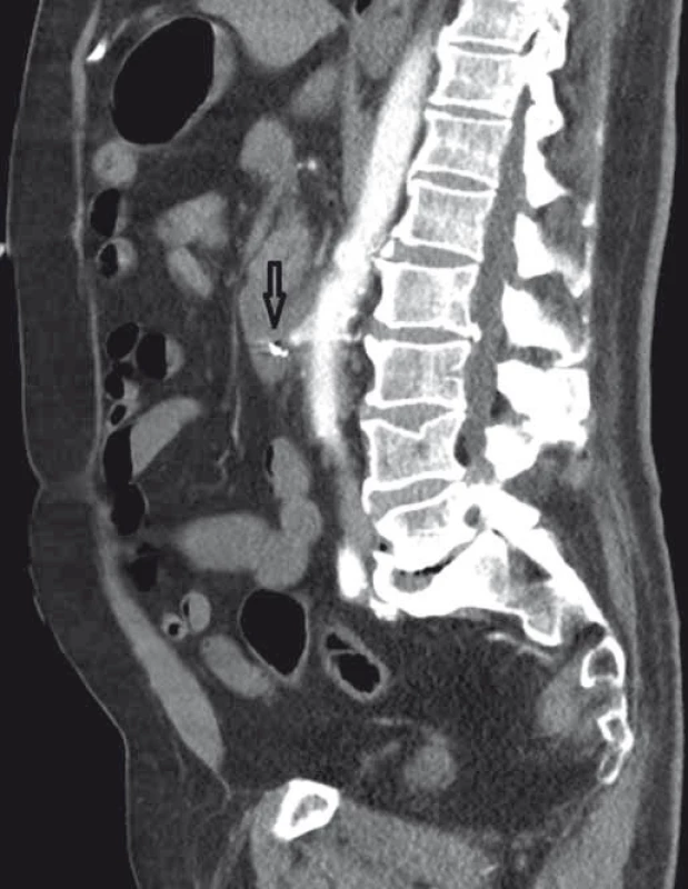 CT angiografie, boční zobrazení, arteriální fáze (šipka ukazuje píštěl).
Fig. 4. CT angiography, lateral view, arterial phase (the arrow points to the fistula).