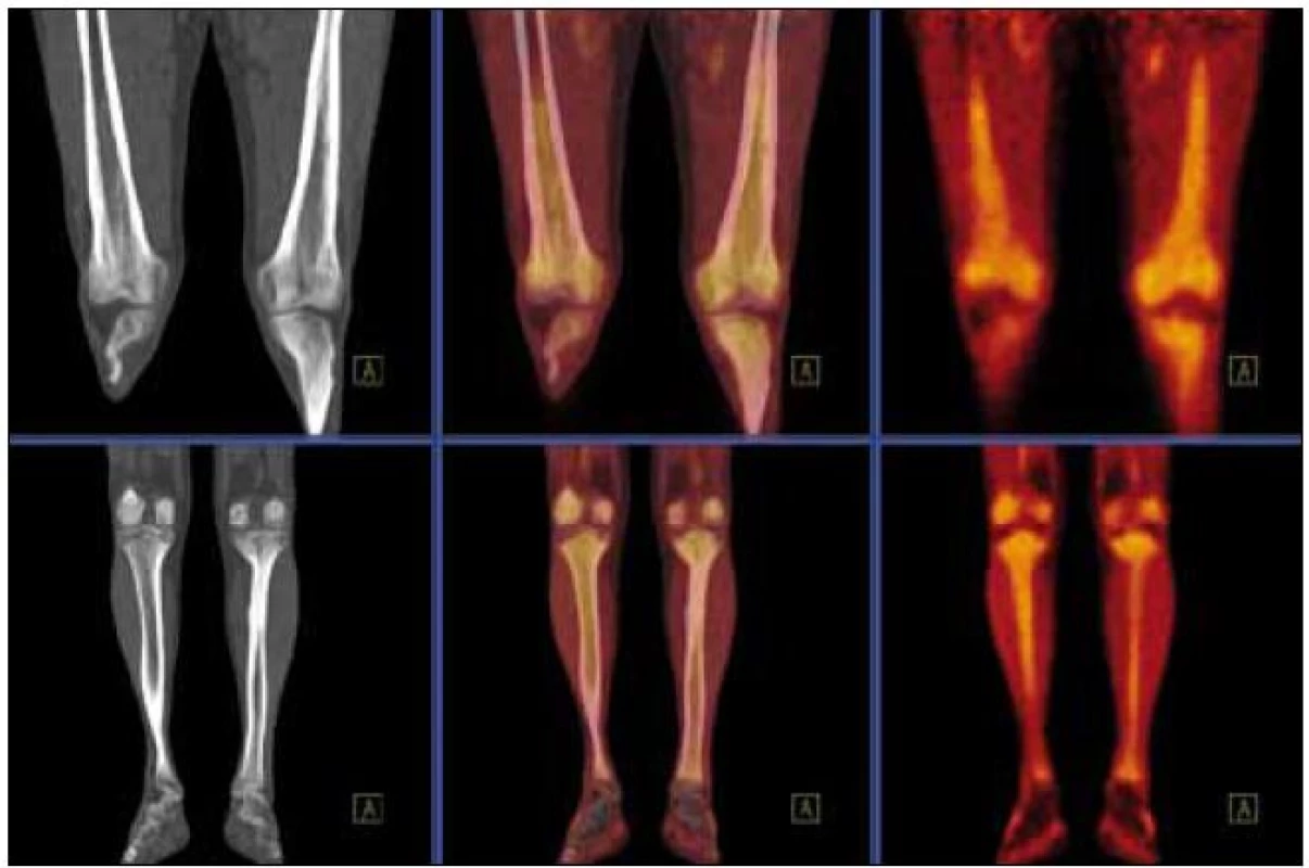 PET-CT zobrazení dolní končetiny. Při CT zobrazení je zřetelné zesílení kortikalis v oblasti tibie i femuru a při fúzi PET-CT pak patologicky zvýšená akumulace fluorodeoxyglukózy v těchto oblastech.
