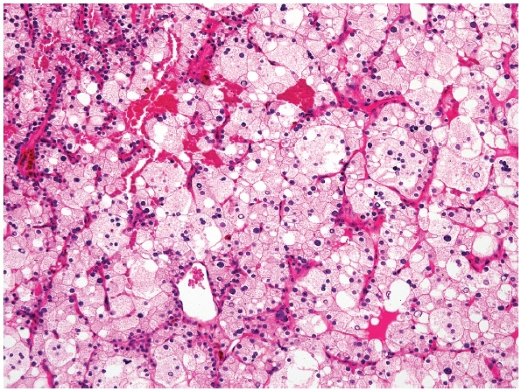 Water-clear cell hyperplasia of the parathyroid gland (magnification 200x).