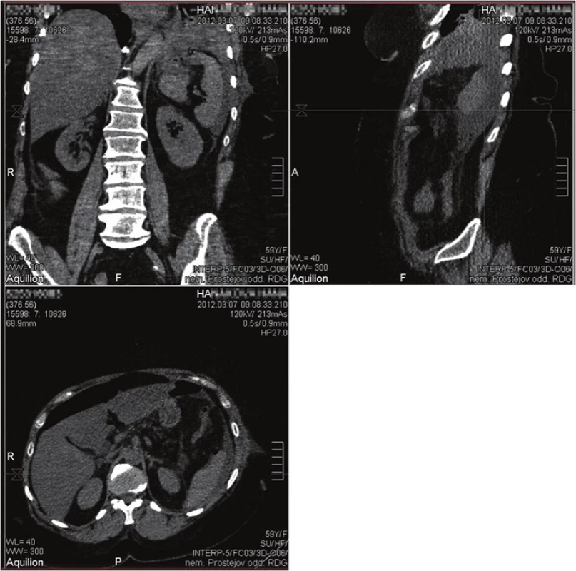 CT s nálezem akutní kolekce v levém podžebří
Fig. 2: CT scan with the finding of an acute left subphrenic collection