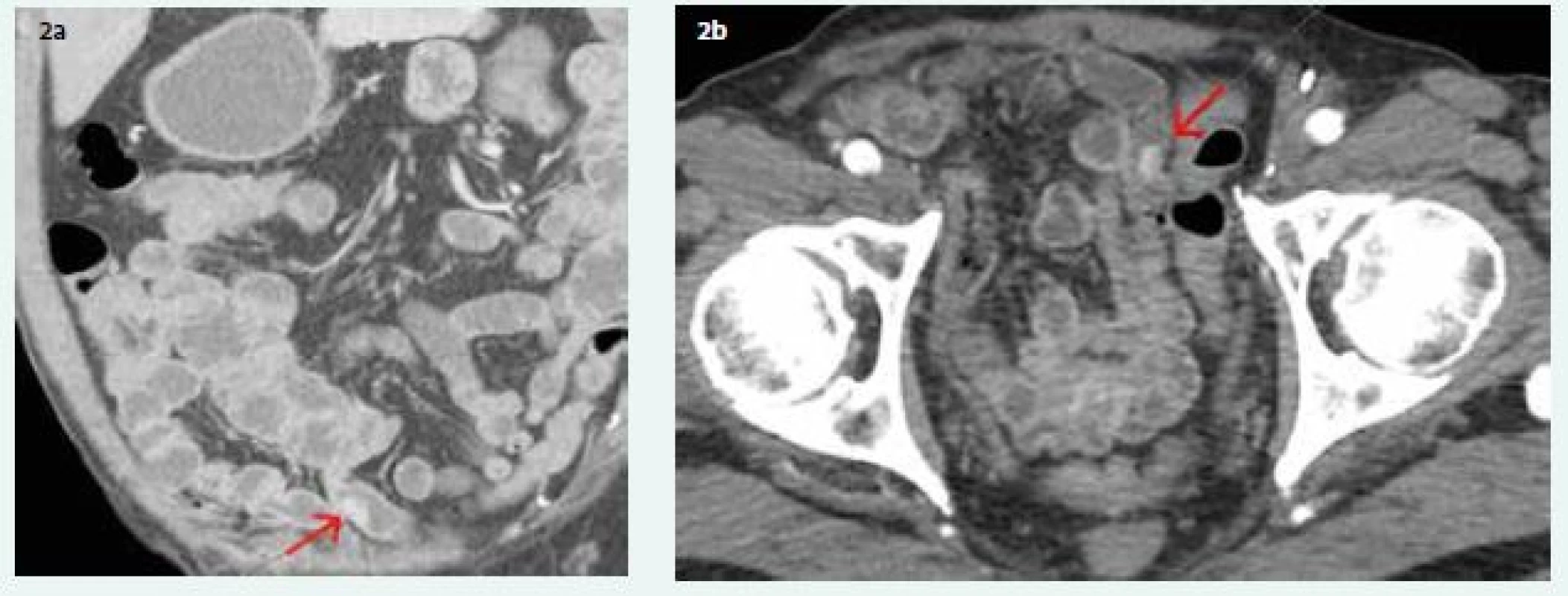 a, 2b. Contrast enhanced CT: a (coronal scan) and b (transversal scan) hypervascularised lesion on ileal
bowel loop (red arrow)