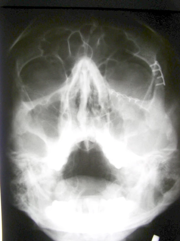 Zlomenina ZMK ošetřena osteosyntézou