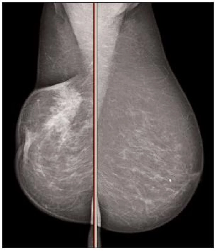 Mamografie pravého prsu
Fig. 6. Mamography of the right breast