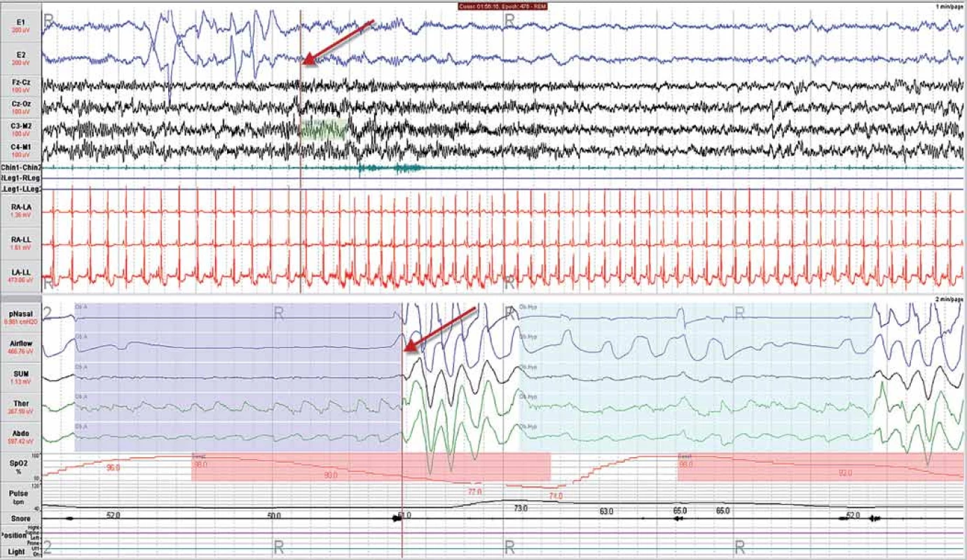 Příklad obstrukční spánkové apnoe (vlevo) a hypopnoe (vpravo). Jsou zřetelné paradoxní pohyby břicha (Abdo) a hrudníku (Thor). Šipky ukazují na místo se stejným časem v polysomnografickém záznamu, kdy respirační událost je doprovázena probouzecí reakcí (arousal). Za pozornost stojí závažnost desaturace, generovaná jednotlivými epizodami SDB. Definice jednotlivých snímaných signálů je uvedena v části: Hodnocení polysomnografického záznamu.